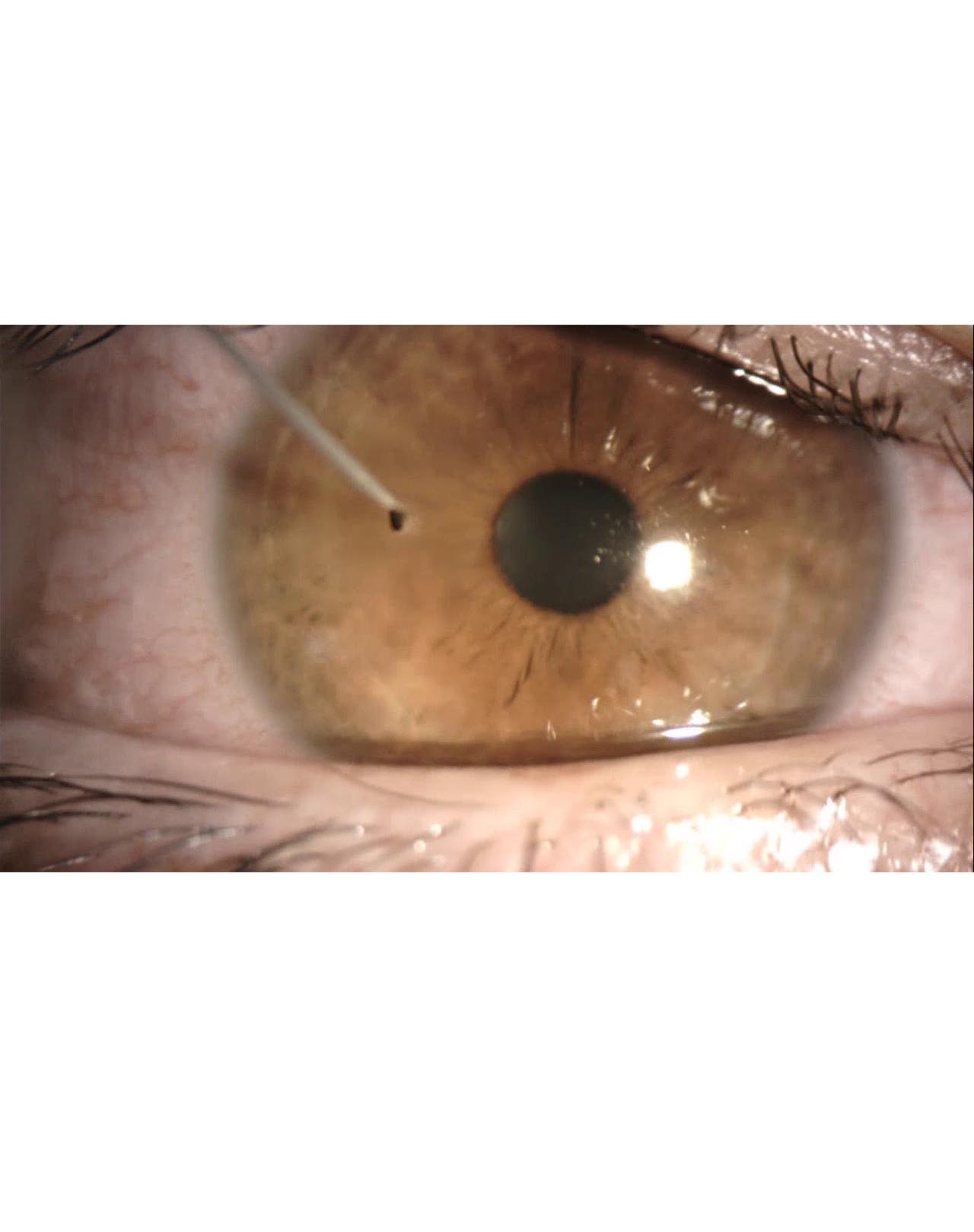 Foreign Body (Removal)